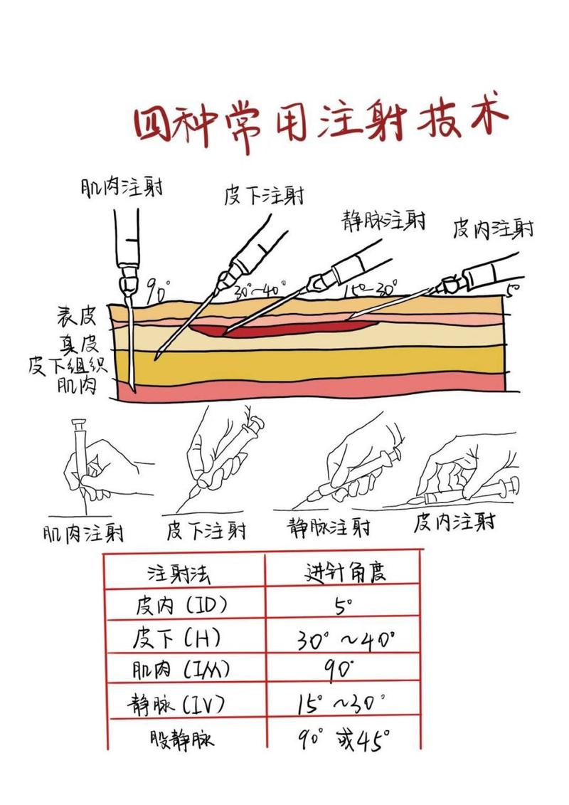  注射术