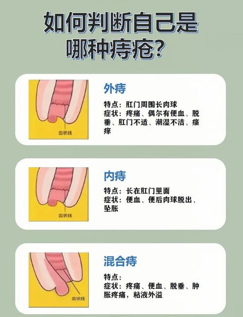 治疗特别大的痔疮有哪些方法？