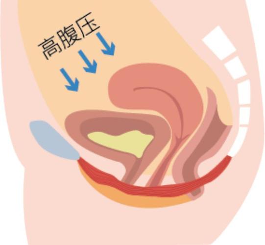 腹压增加