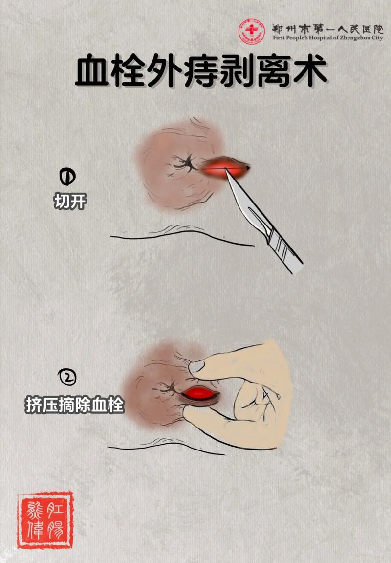 血栓性痔疮