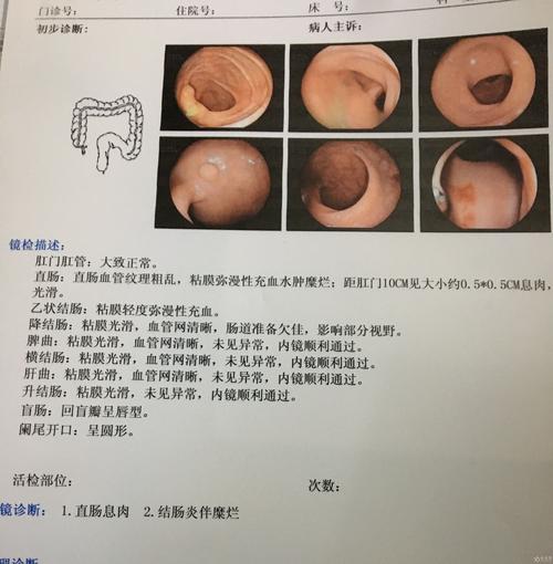 直肠息肉