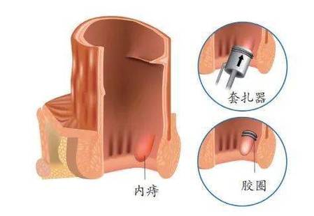 痔疮没有紧扎会自行脱落吗？