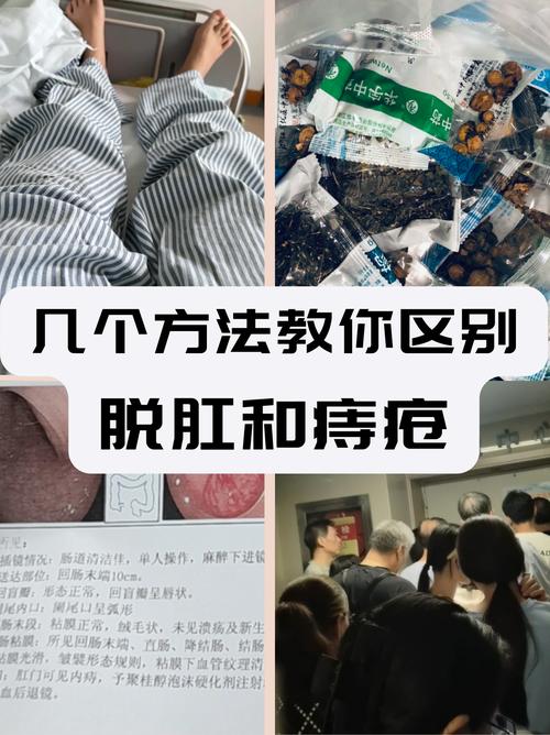 痔疮栓剂能治疗直肠脱垂吗？