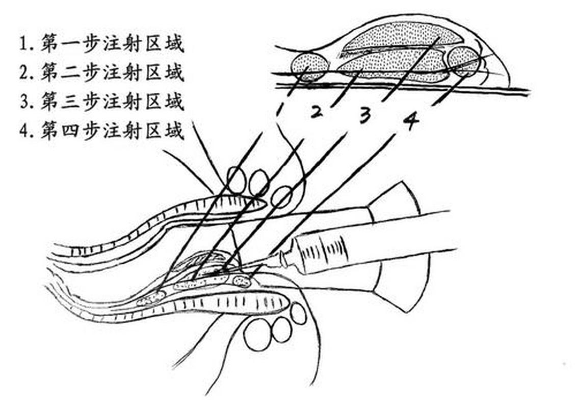 痔疮注射法