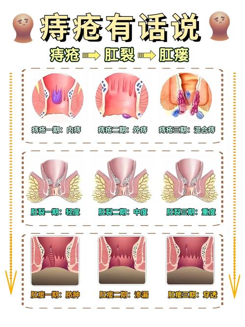 痔疮真的能被拉出体外吗？