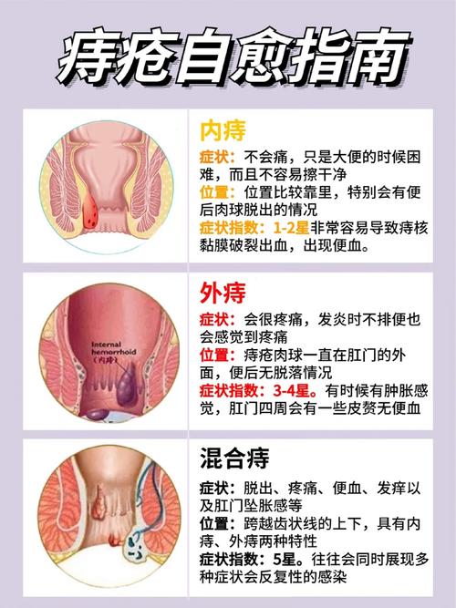 老痔疮