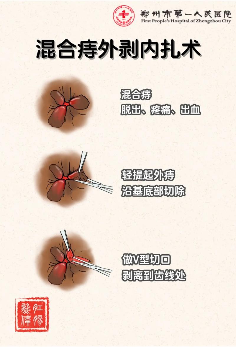 痔疮解决方法