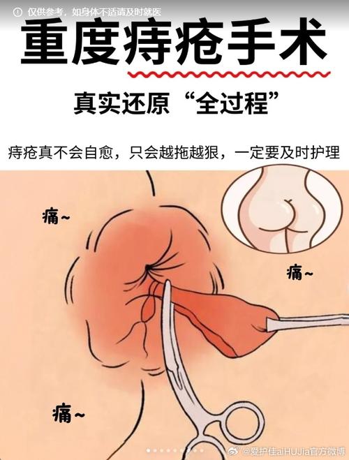 痔疮术后：为何屁股抽痛？