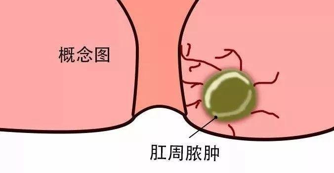 肛周硬块