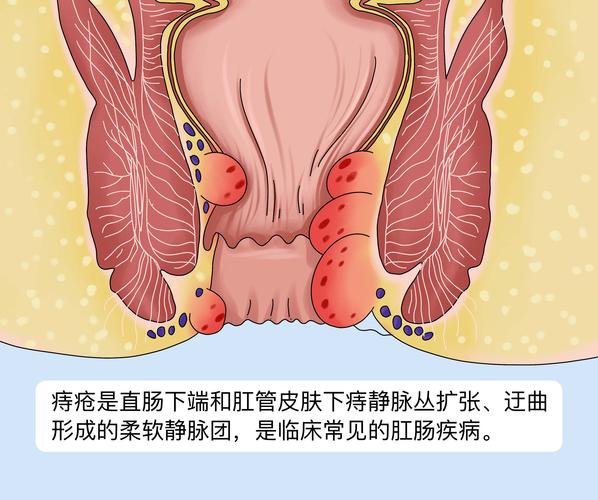 得痔疮会不会长出包块？