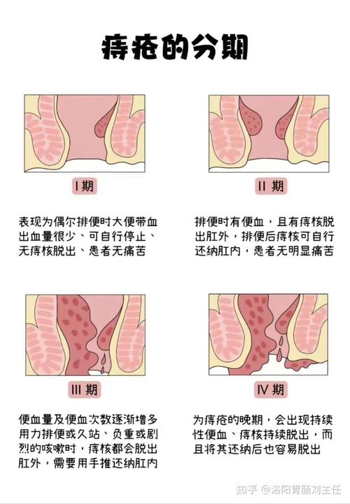 痔疮内痔期