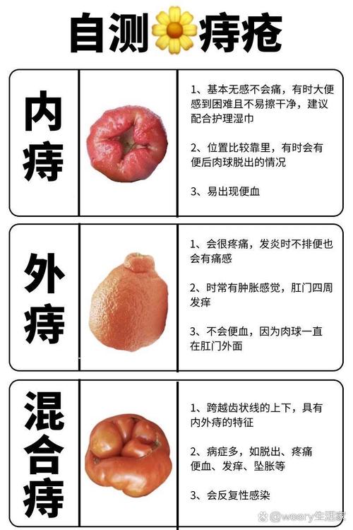 吃辣对治疗痔疮有影响吗？