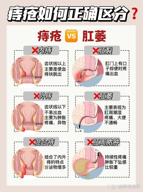 有痔疮能否顺利迎接二胎的到来？