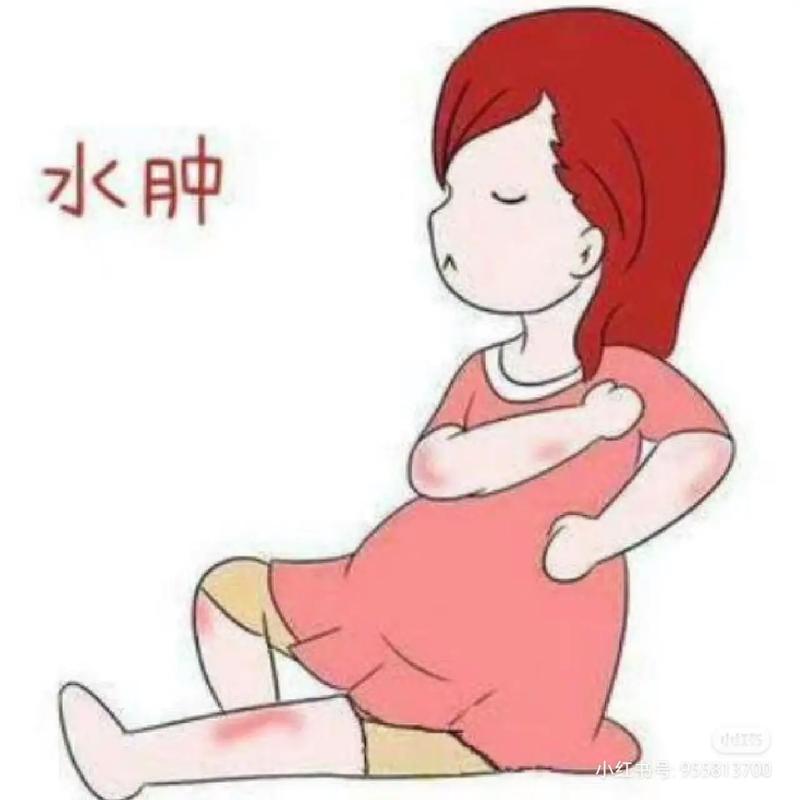 孕妇水肿