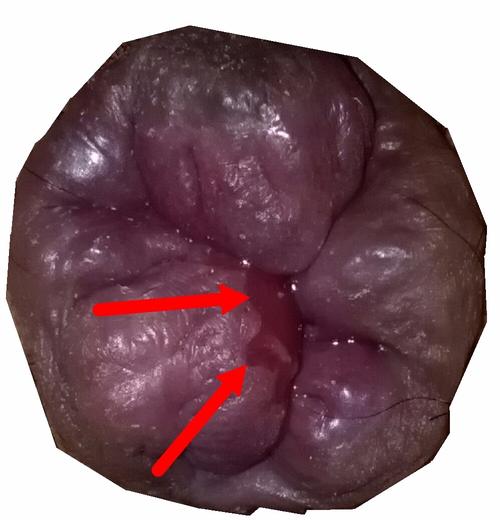 痔疮溃疡：肿块形成是否常见？