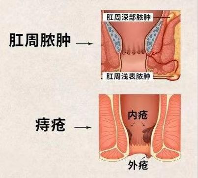 痔疮硬块触碰即痛，如何缓解？