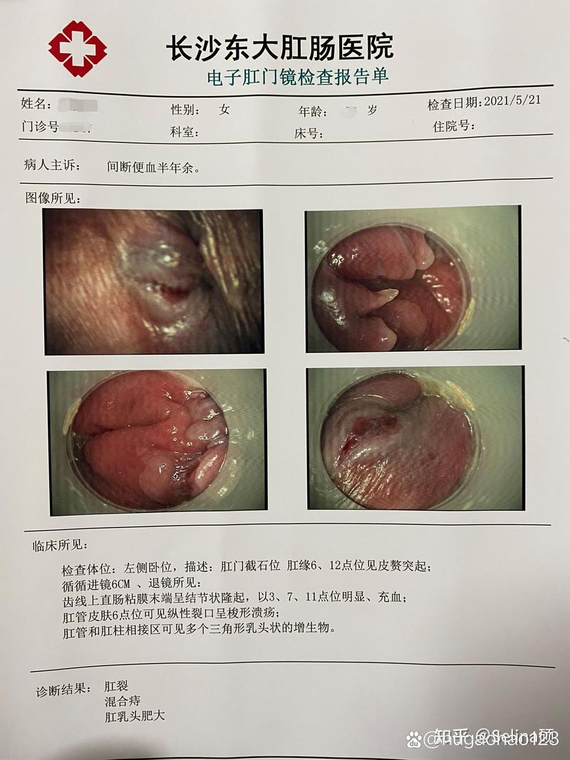 治疗痔疮医院