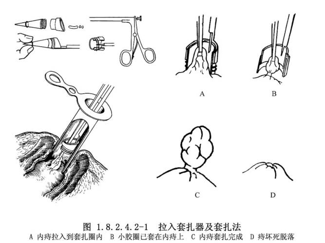 胶圈套扎法