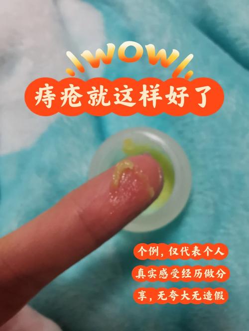 顺产后痔疮多久能痊愈？