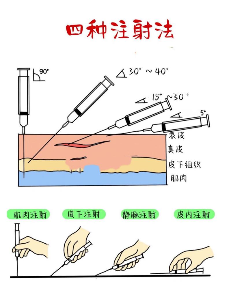 硬化剂注射术