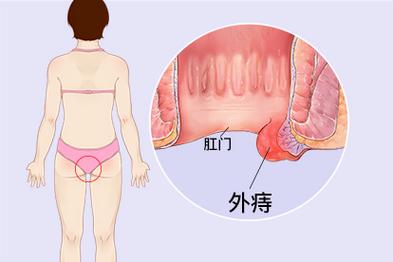 小痔疮