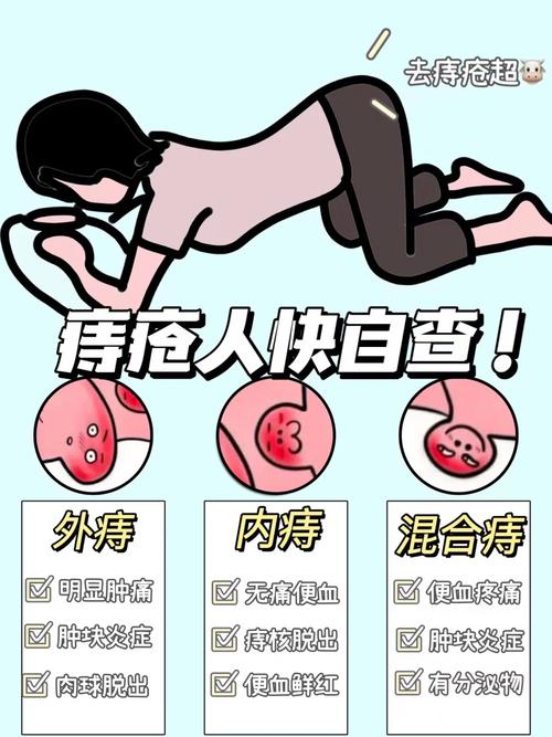 痔疮治疗有妙招，你知道吗？