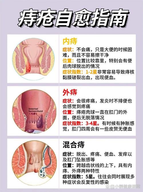 痔疮早期是否能治愈？