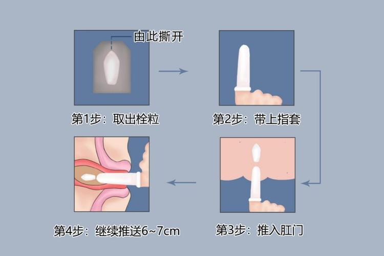 肛门用药疗法