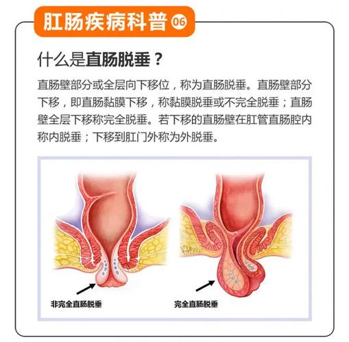 痔疮脱出与嵌顿的区别是什么？