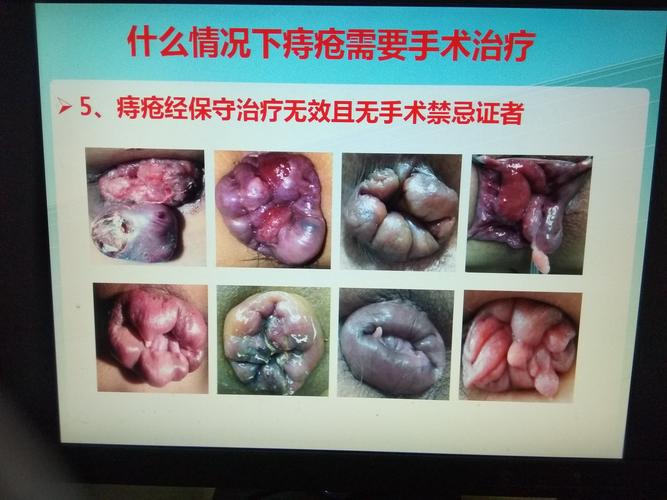 痔疮可以通过保守治疗痊愈吗？