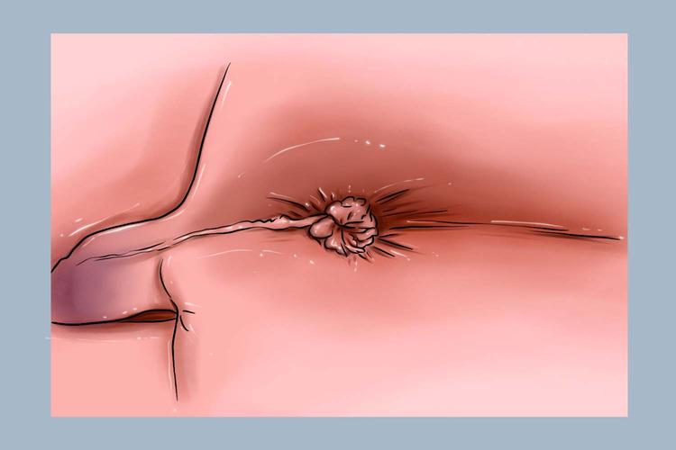 刚长出的痔疮