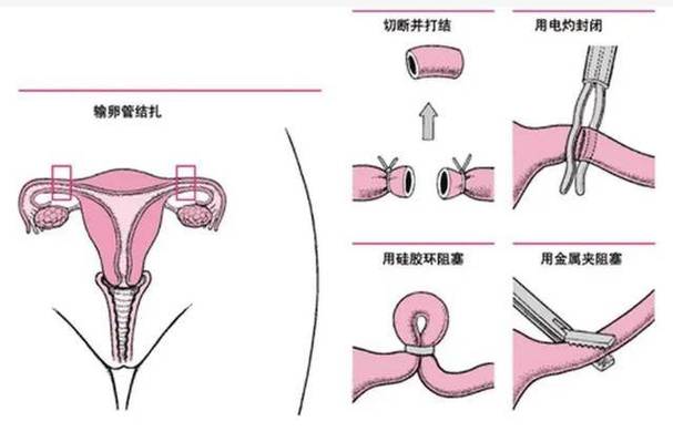 结扎术