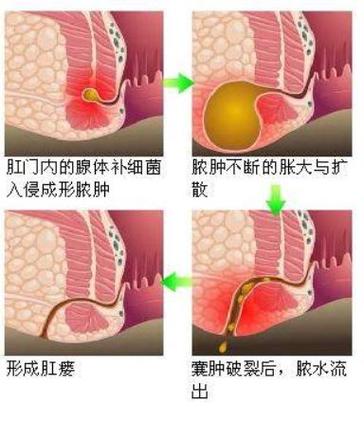 脓痔疮