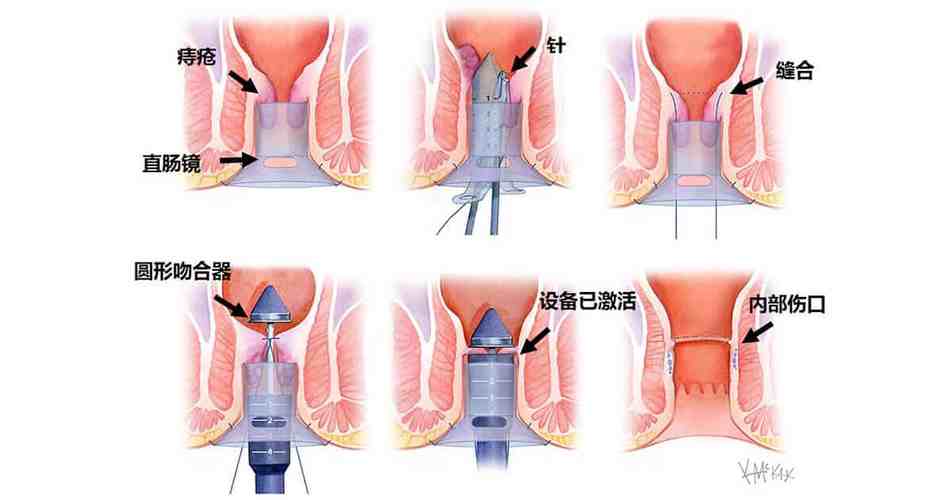 痔疮微波治疗