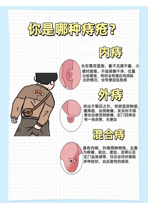 女生久坐是否容易得痔疮？