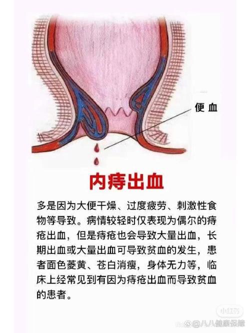 痔疮急性发作