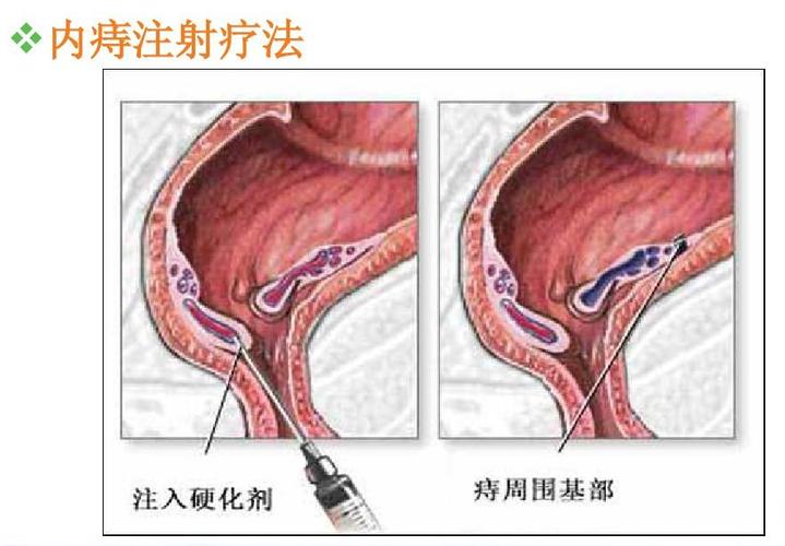 痔疮注射治疗