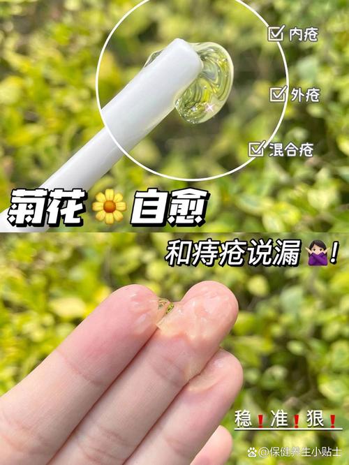 痔疮硬核是什么？如何处理？