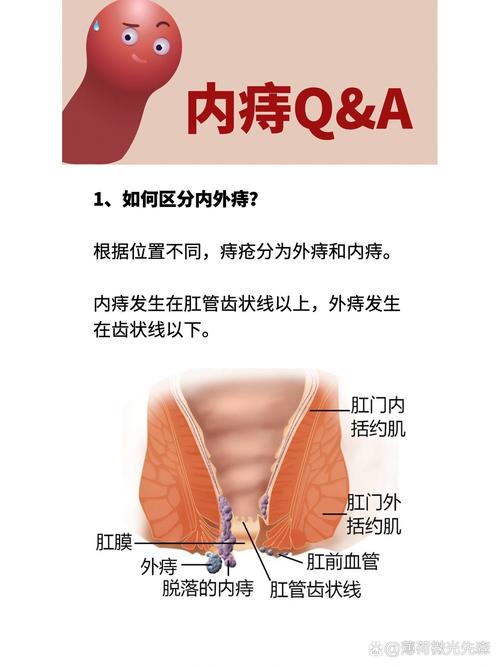 女生痔疮是否会影响全身健康？