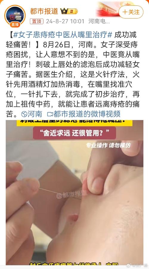 激光疗法：痔疮治疗新选择？