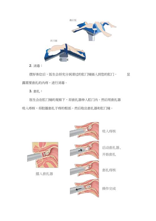 痔疮家庭疗法