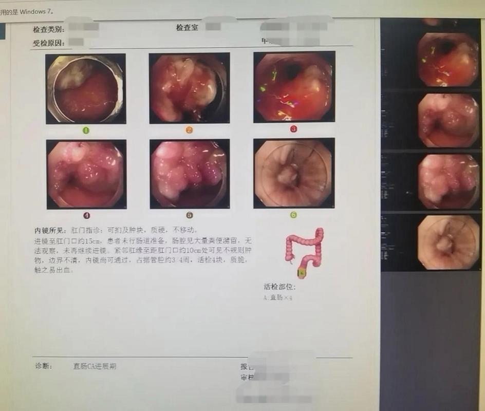 痔疮检查项目