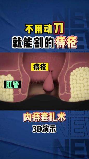 割痔疮时是否需要进行侧切？