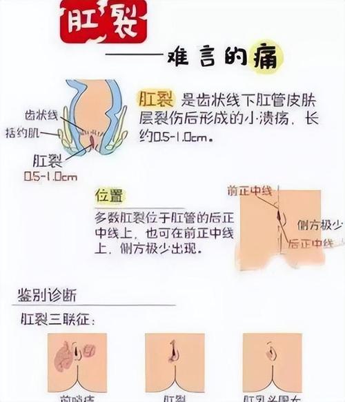 肛门凹陷