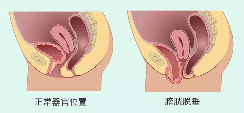 产后女性