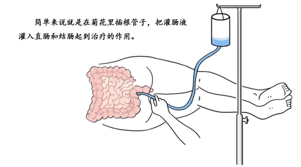 术前灌肠