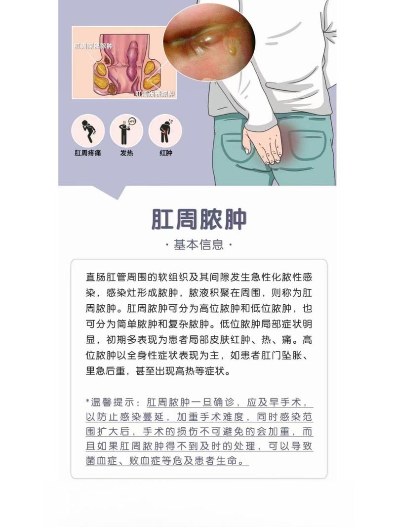 痔疮脓肿能引发高烧吗？