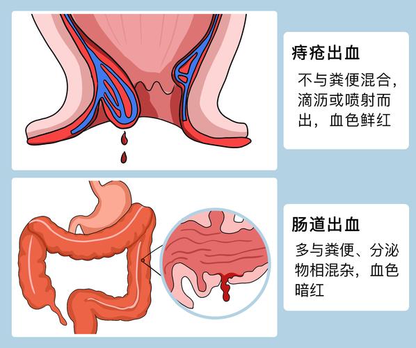 如何发现并处理痔疮出血点？