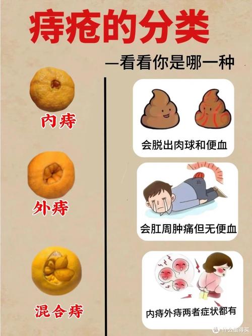 发现痔疮后怎么治疗是最佳方法？