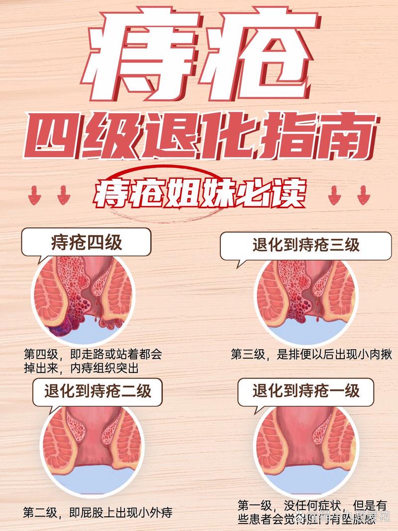 减肥后痔疮是否不再作痛？